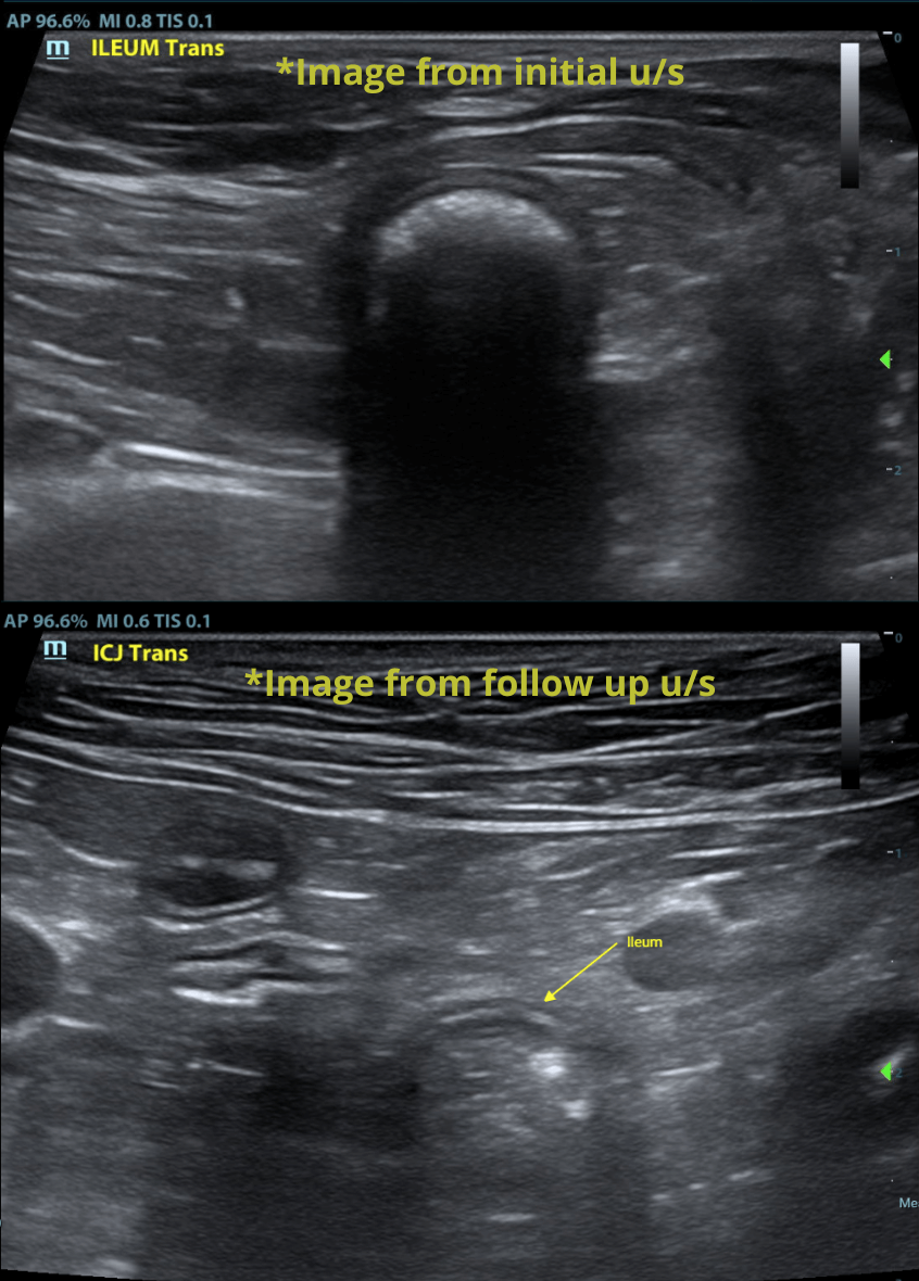 Ileum_Colon
