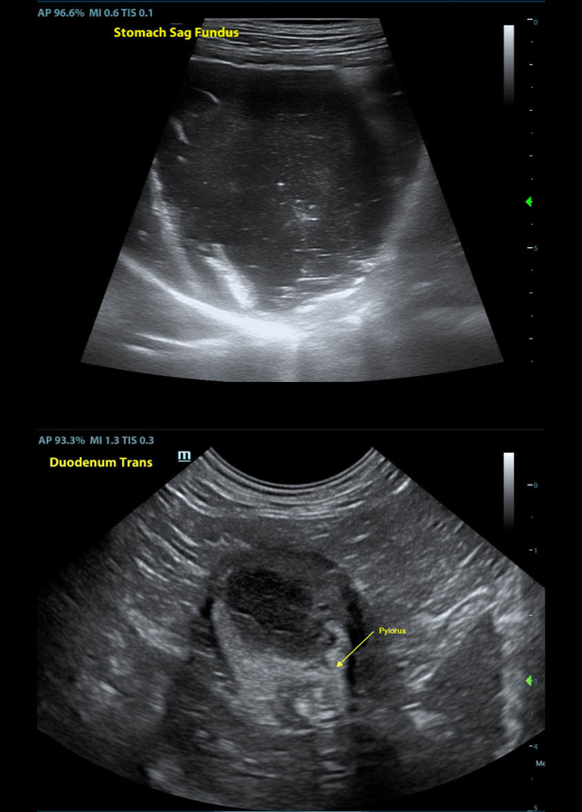 Stomach and Pylorus