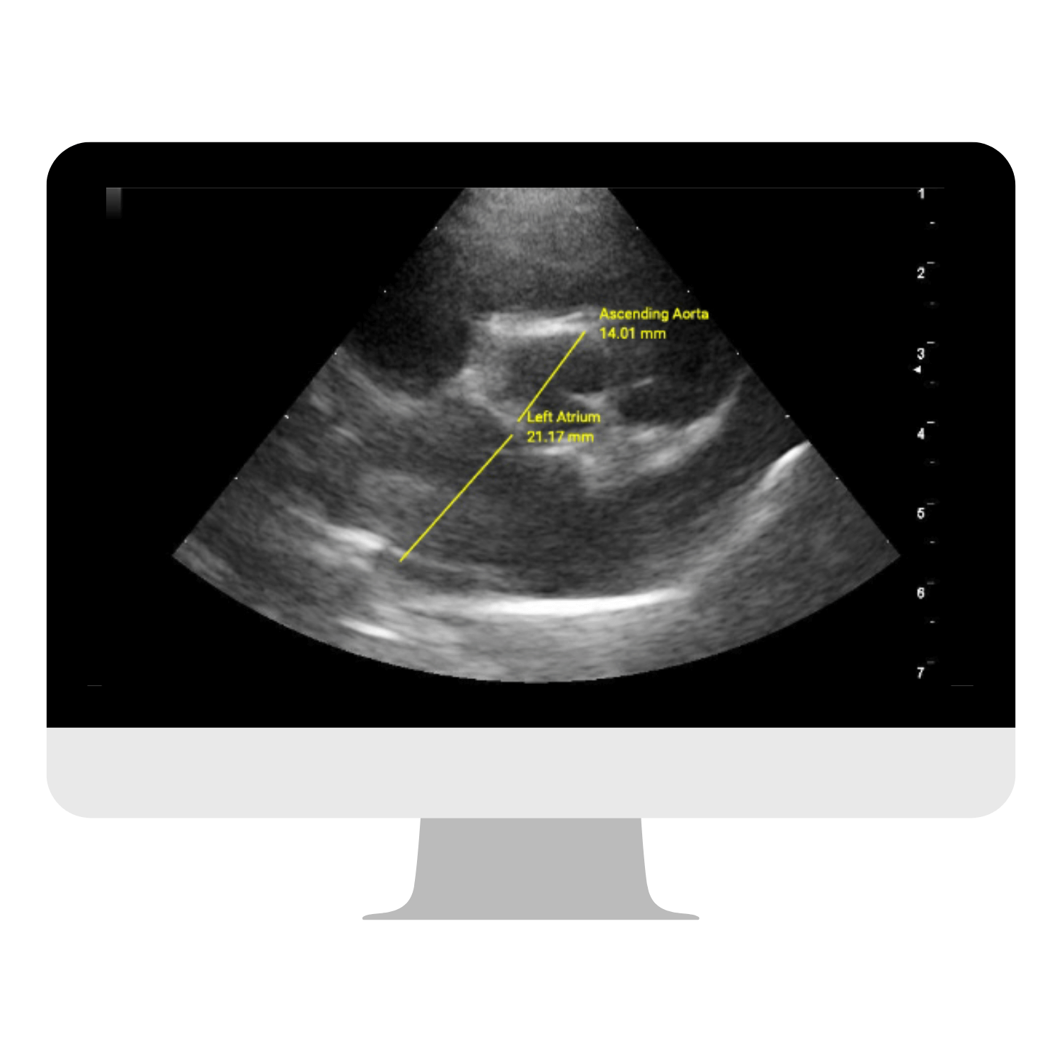 Western Michigan - Degenerative Mitral Valve Disease
