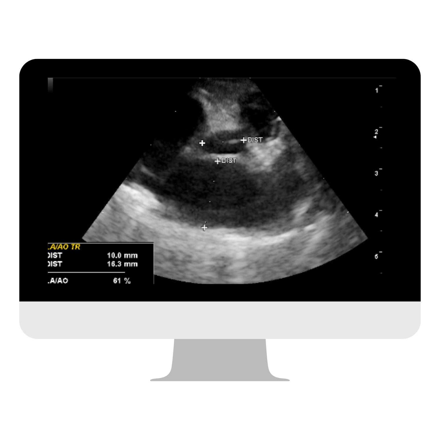 Western Michigan - Hypertrophic Cardiomyopathy