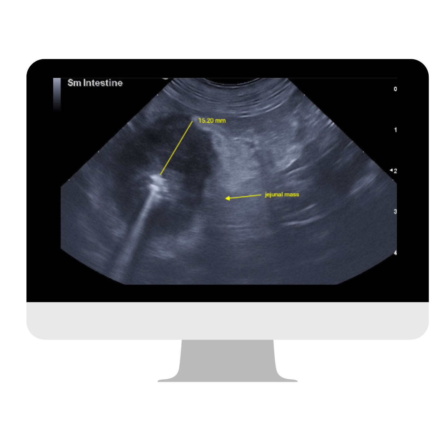 Western Michigan - Jejunal Mass