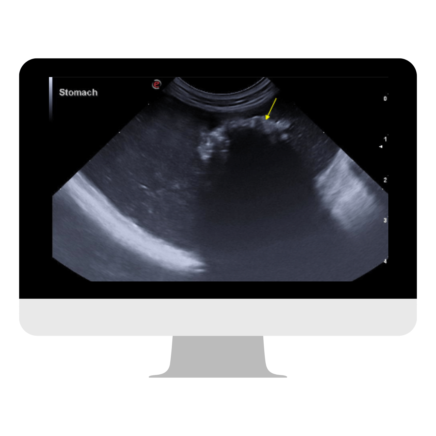 Western Michigan - Proximal Duodenal FB