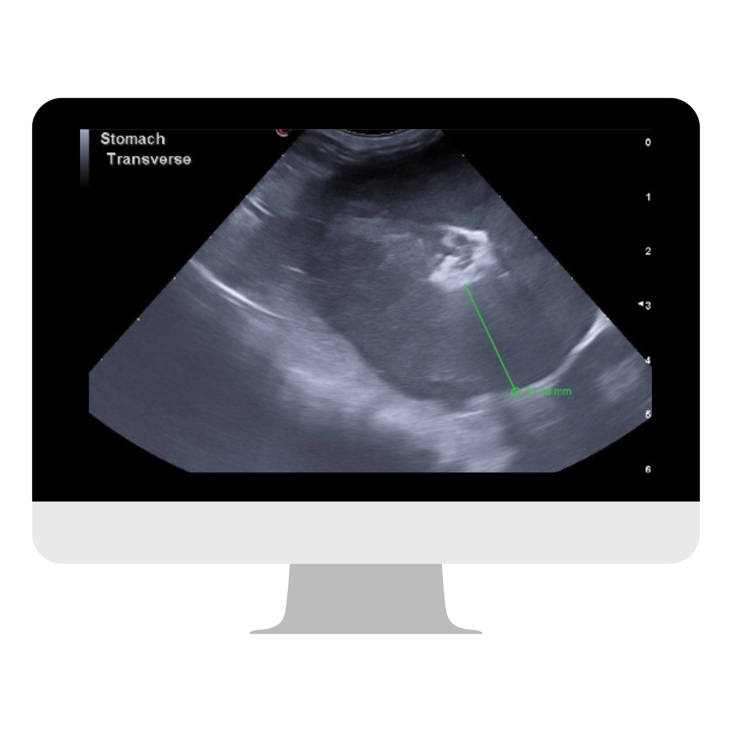 Western Michigan - Suspected Gastric Neoplasia
