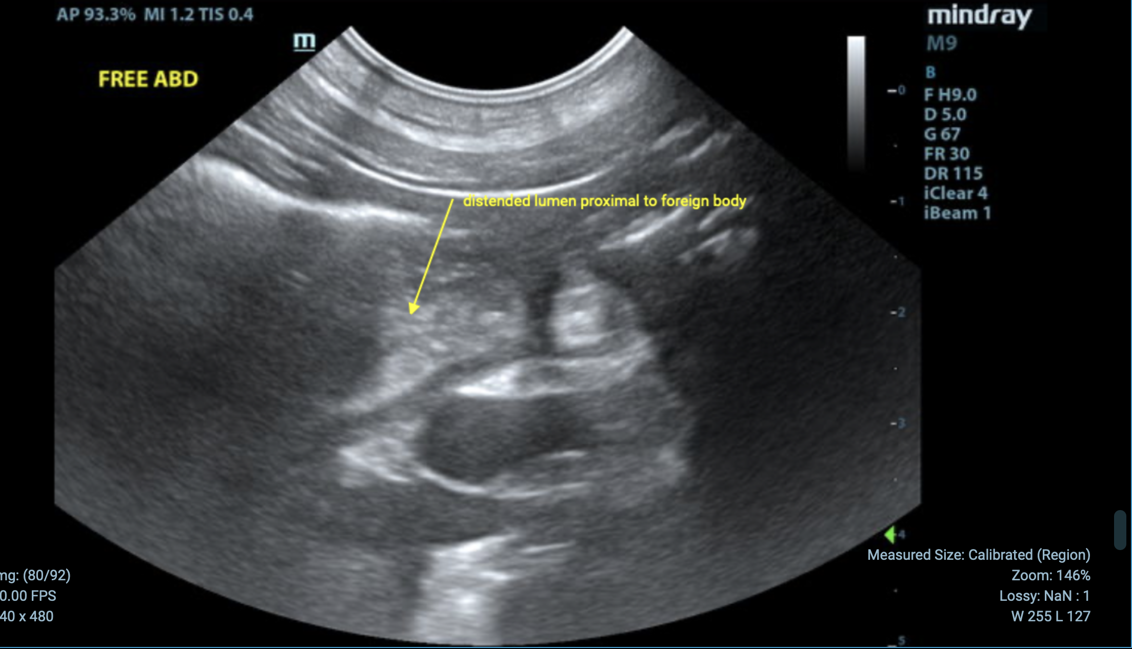 Going on an Ultrasound Foreign Body Hunt