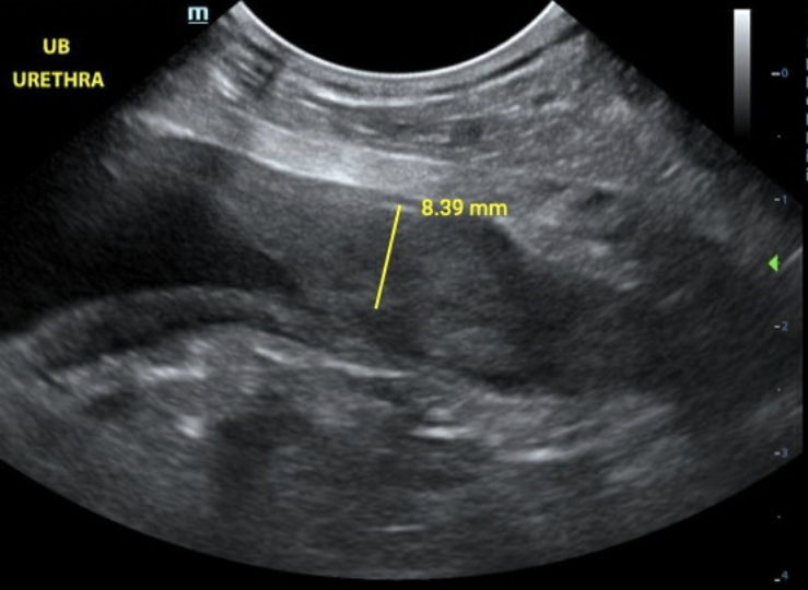 The Importance of Urethral Imaging in Bladder Ultrasound: A Case Study and Practical Techniques