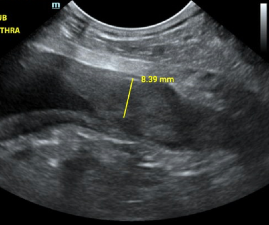 Urethra US